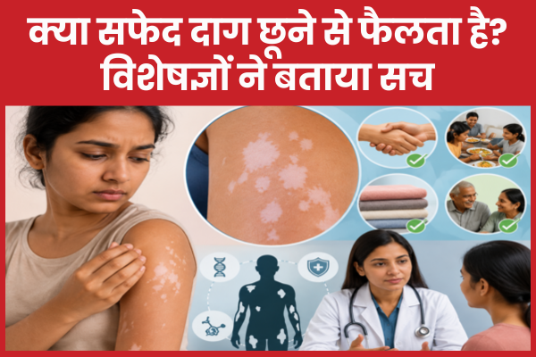 क्या सफेद दाग छूने से फैलता है? विशेषज्ञों ने बताया सच सफेद